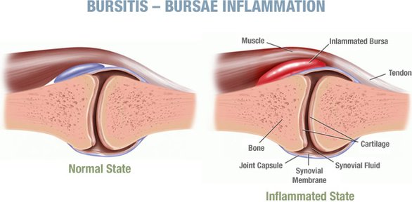 inflamation bursa